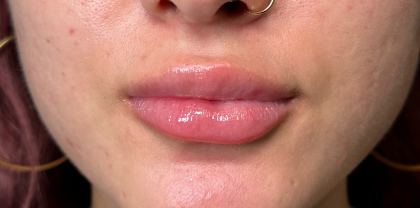 Filler Before & After Patient #4419