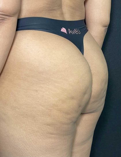 Aveli Before & After Patient #4453