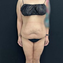 Tummy Tuck Before & After Patient #4593
