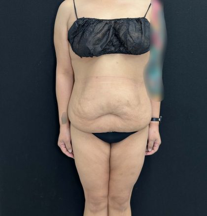 Tummy Tuck Before & After Patient #4593