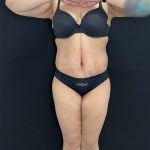 Tummy Tuck Before & After Patient #4593