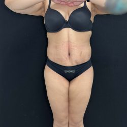 Tummy Tuck Before & After Patient #4593
