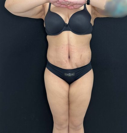 Tummy Tuck Before & After Patient #4593