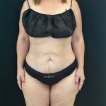 Tummy Tuck Before & After Patient #4594