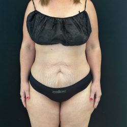 Tummy Tuck Before & After Patient #4594