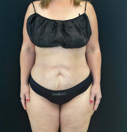 Tummy Tuck Before & After Patient #4594