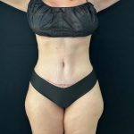 Tummy Tuck Before & After Patient #4594