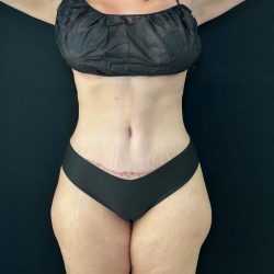 Tummy Tuck Before & After Patient #4594