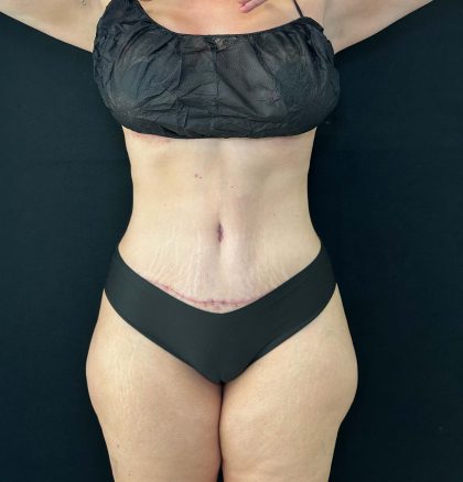 Tummy Tuck Before & After Patient #4594
