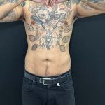 Liposuction Before & After Patient #4581