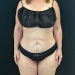 Tummy Tuck Before & After Patient #4580