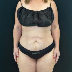 Tummy Tuck Before & After Patient #4580