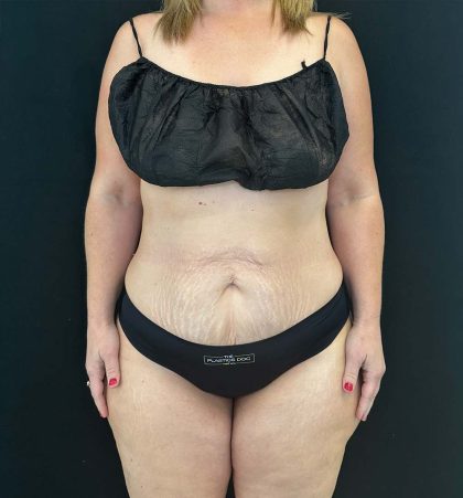 Tummy Tuck Before & After Patient #4580