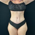 Tummy Tuck Before & After Patient #4580
