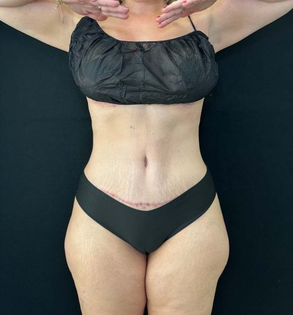 Tummy Tuck Before & After Patient #4580
