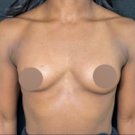 Breast Augmentation Before & After Patient #4478