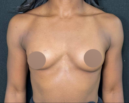 Breast Augmentation Before & After Patient #4478