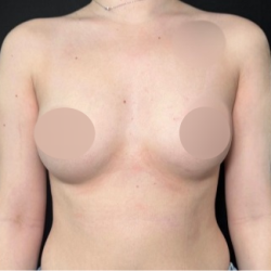Breast Augmentation Before & After Patient #4479