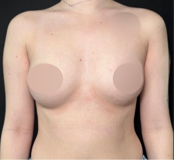 Breast Augmentation Before & After Patient #4479