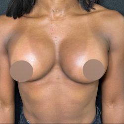 Breast Augmentation Before & After Patient #4478