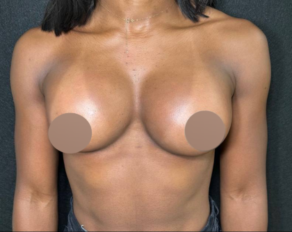 Breast Augmentation Before & After Patient #4478