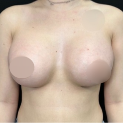 Breast Augmentation Before & After Patient #4479
