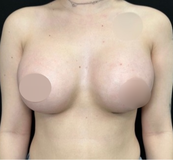 Breast Augmentation Before & After Patient #4479