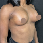Breast Augmentation Before & After Patient #4478