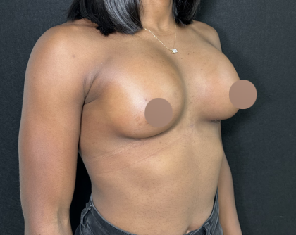 Breast Augmentation Before & After Patient #4478