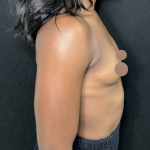 Breast Augmentation Before & After Patient #4478