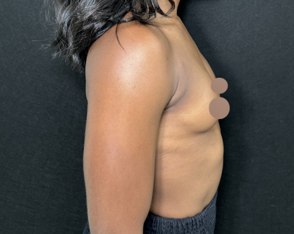Breast Augmentation Before & After Patient #4478