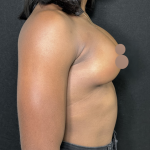 Breast Augmentation Before & After Patient #4478
