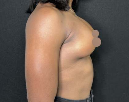 Breast Augmentation Before & After Patient #4478