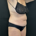 Tummy Tuck Before & After Patient #4671