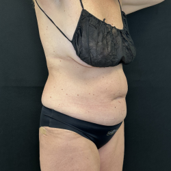 Tummy Tuck Before & After Patient #4671