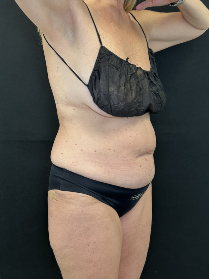 Tummy Tuck Before & After Patient #4671