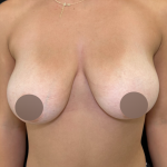 Breast Reduction Before & After Patient #4754