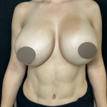 Breast Lift Before & After Patient #4755