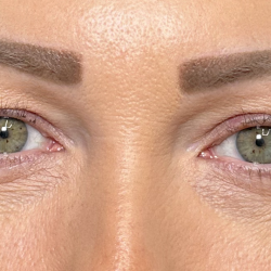 Eyelid Lift Before & After Patient #4756