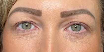 Eyelid Lift Before & After Patient #4756