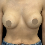 Breast Lift Before & After Patient #4757