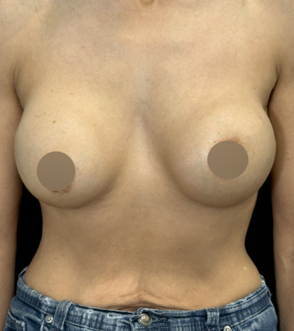 Breast Lift Before & After Patient #4757