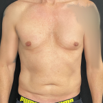 Liposuction Before & After Patient #4670