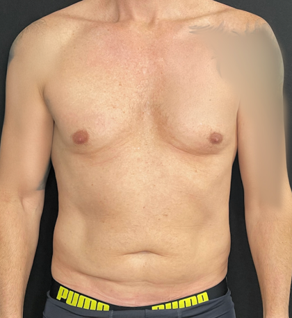 Liposuction Before & After Patient #4670