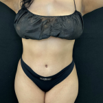 Liposuction Before & After Patient #4760