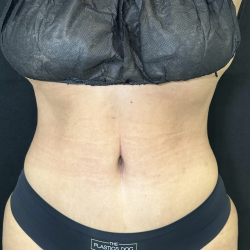 Tummy Tuck Before & After Patient #4663