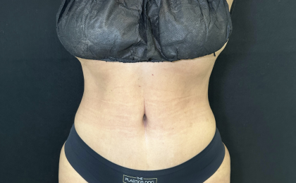 Tummy Tuck Before & After Patient #4663