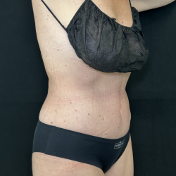 Tummy Tuck Before & After Patient #4671