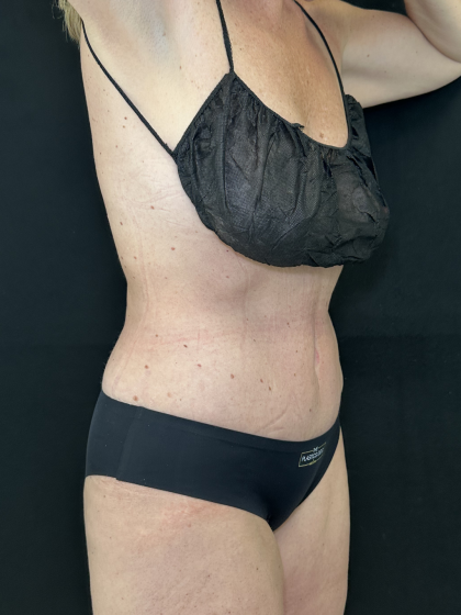 Tummy Tuck Before & After Patient #4671
