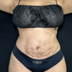 Tummy Tuck Before & After Patient #4762